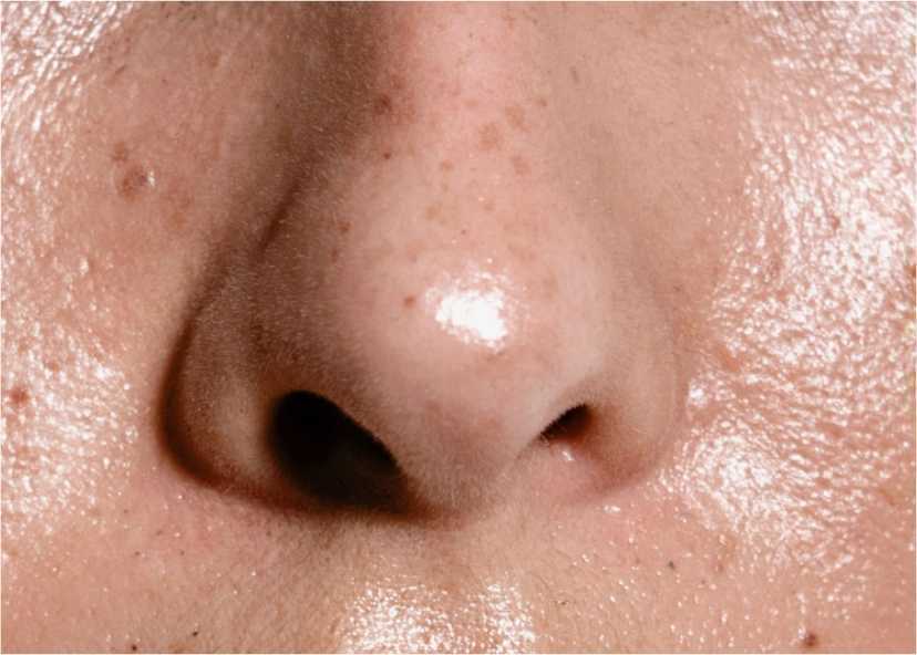 Cara Menghilangkan Jerawat: Tips Ampuh untuk Kulit Bersih dan Bebas Jerawat 4 Perawatan Kulit Berminyak