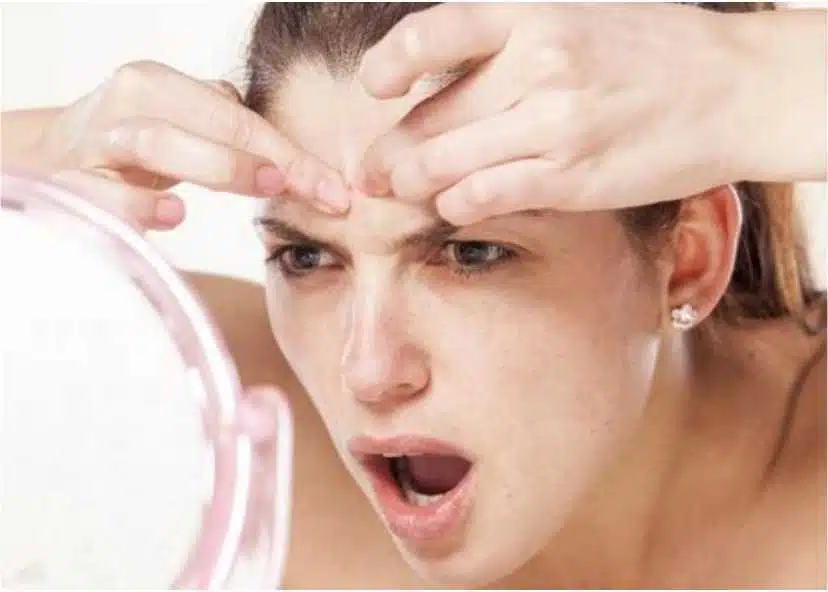 Manfaat Serum Hanasui Anti Acne untuk Kulit Wajah Bebas Jerawat