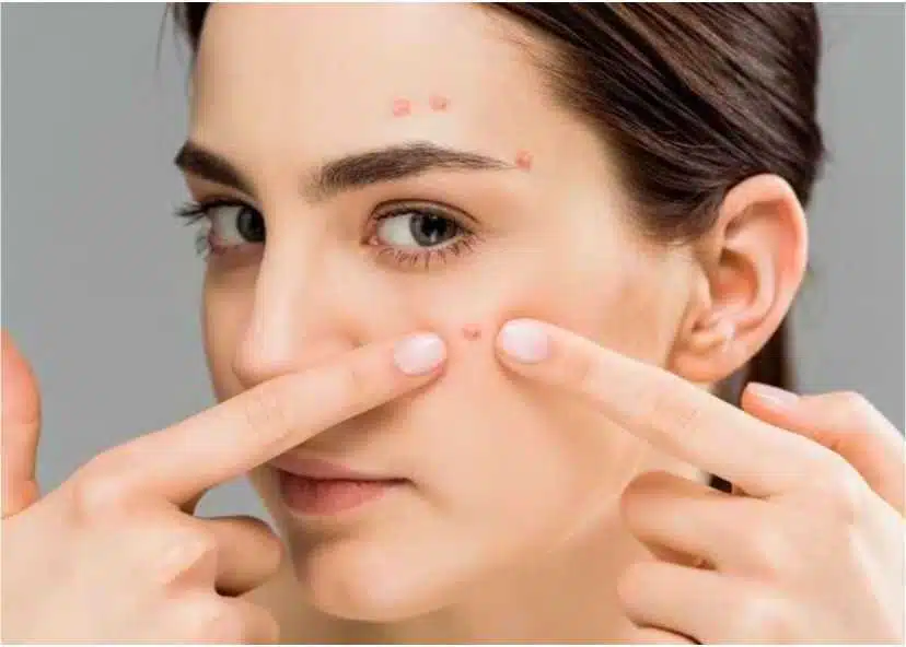 Serum Hanasui Anti Acne: Solusi Ampuh Mengatasi Jerawat