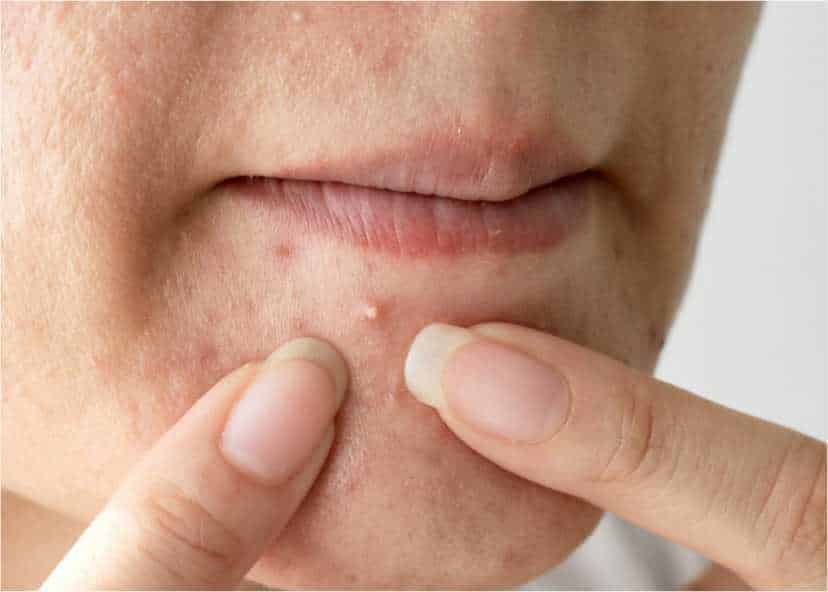 Serum Hanasui Gold untuk Jerawat: Kandungan, Manfaat, dan Cara Penggunaan