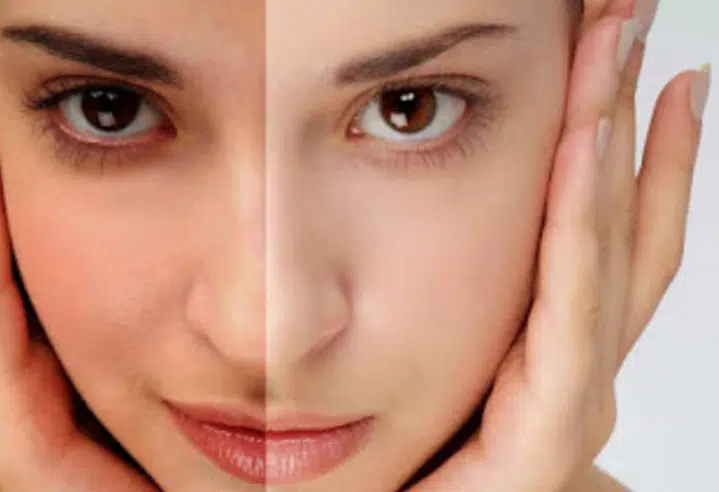 cara menghilangkan muka belang