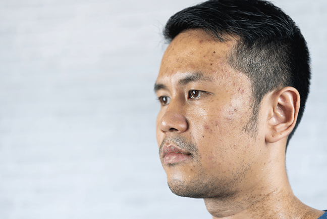 Cara Mengatasi Kulit Kusam Dalam Satu Malam 1 Cara Mengatasi Kulit Kusam